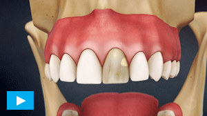 Dental Crowns Etobicoke