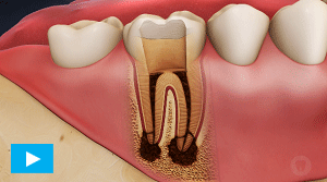 Root Canal Therapy Etobicoke